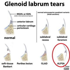 Types of Labral tears
