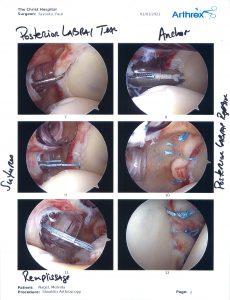 Arthroscopy photos of my right shoulder